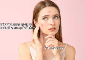 Yetişkinlerde Sivilce Problemi Nasıl Çözülür?