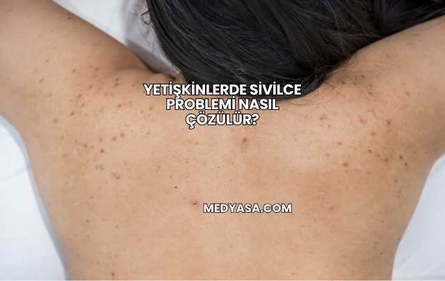 Yetişkinlerde Sivilce Problemi Nasıl Çözülür?