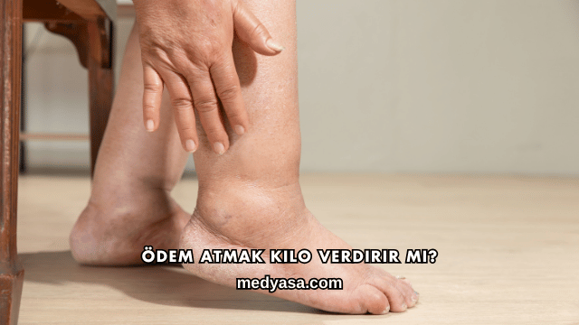 Ödem Atmak Kilo Verdirir mi?